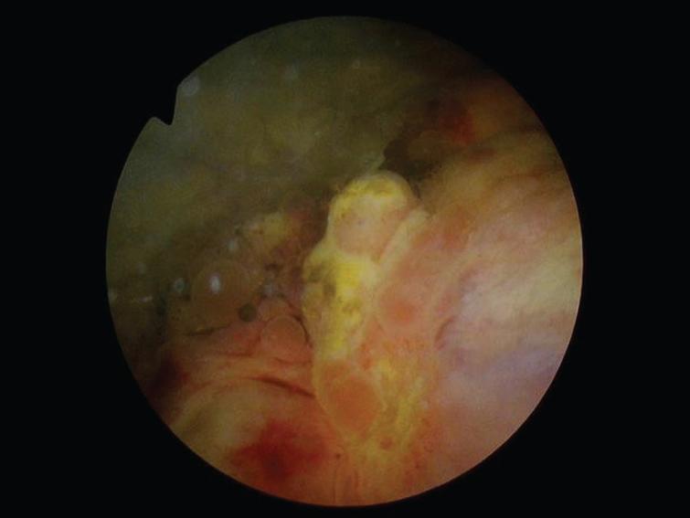 Sessile tumor left trigone/lateral wall.