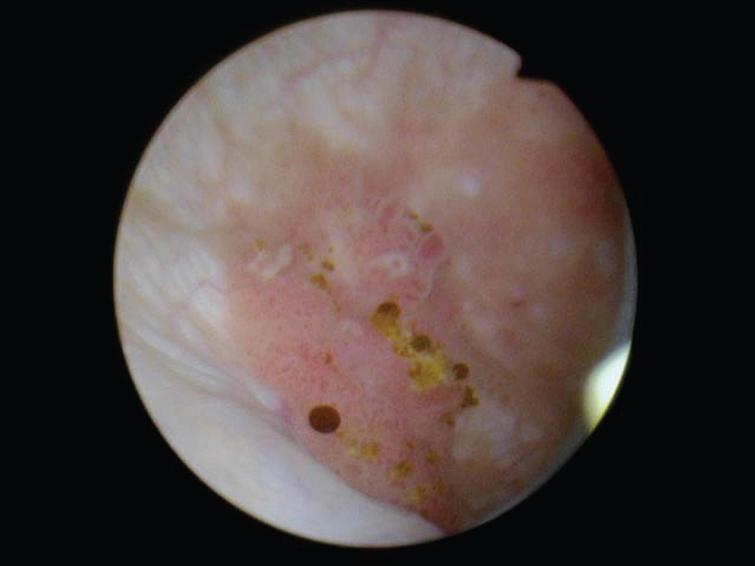 Papillary tumor medial to the sessile tumor.