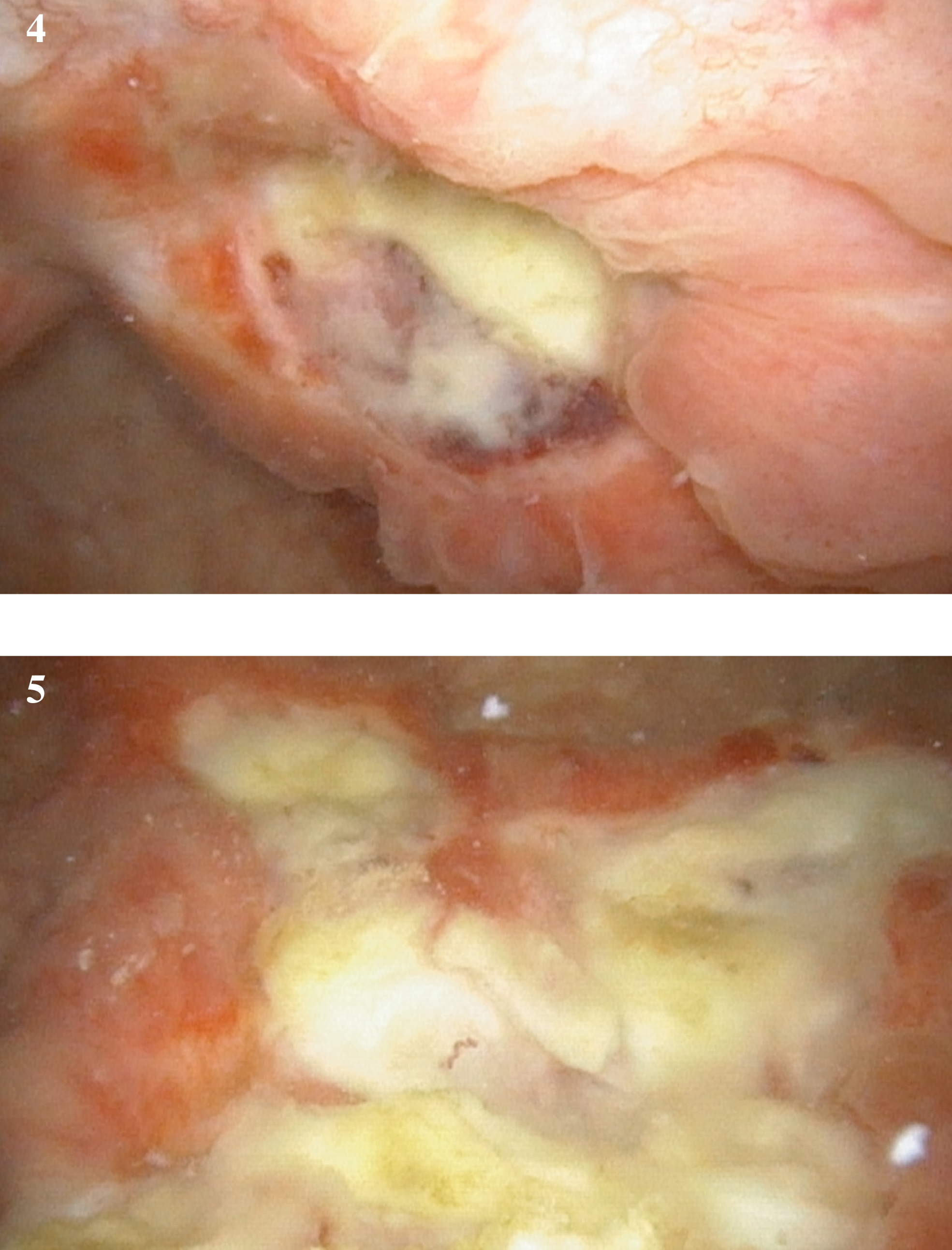 Cystoscopic appearance of mitomycin effect.