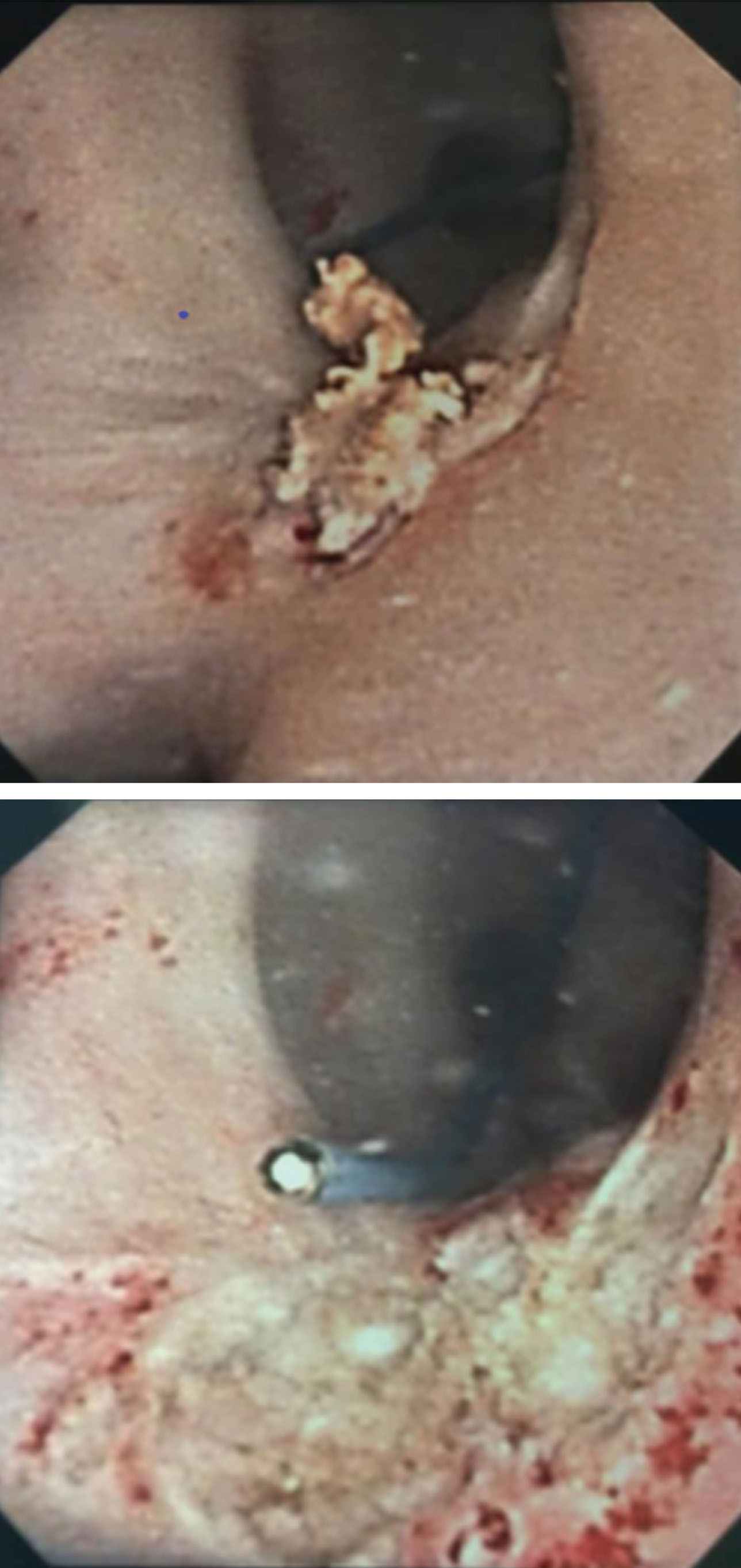 Top image displays small renal pelvis tumor captured on ureteroscopy. Following several weeks of intracavitary MitoGel demonstrated chemoablation with necrotic tumor and no evidence of viable cancer.