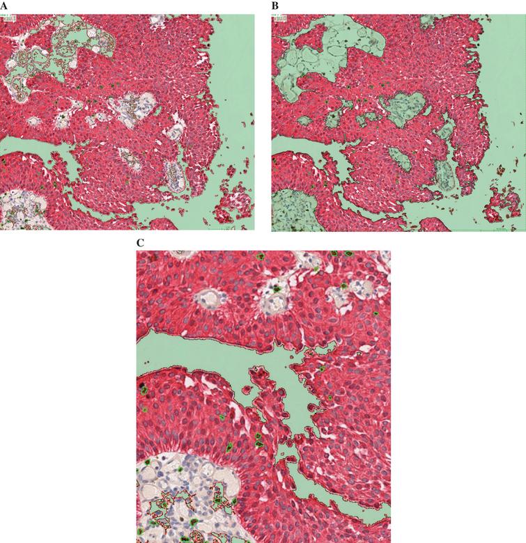 After digitalization of the slides using the Aperio scanscope XT, Leica scanner, Calopix™ software (Tribvn, France) allowed background suppression (green) and separate recognition of tumour (pink) and stroma (white) (Fig. 1A). Secondly, the count could be performed exclusively in the tumour, suppressing the stroma (Fig. 1B). CD8+ cells were automatically identified using a combination of colour, shape and size recognition (see CD8+ cells circled in green, Fig. 1C).