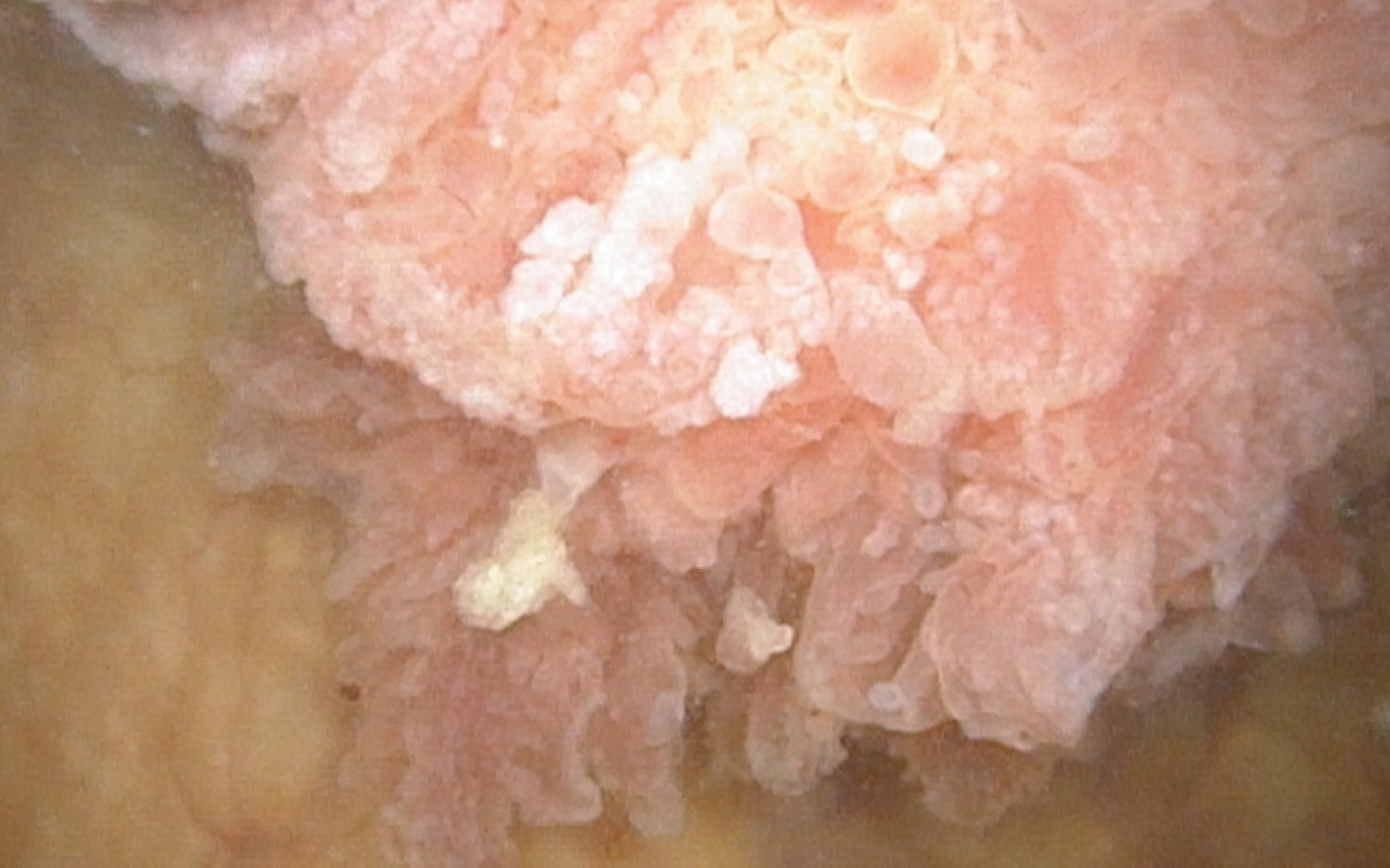 Large papillary tumor.