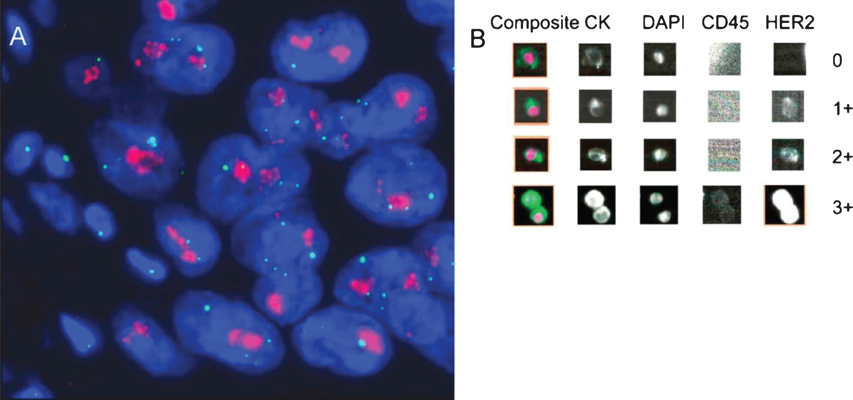 Determination of human epidermal growth factor receptor 2 (HER2) status by (A) fluorescent in situ hybridization and (B) immunofluorescence using the CellSearch CTC assay system. (A) Primary tumor with strong HER2 gene amplification (clusters of HER2 signals: red; CEP17 signals: green); (B) circulating tumor cells detected with the CellSearch system (0: HER2 negative; 1+: weak; 2+: moderate; 3+: strong intensity of HER2-specific immunofluorescence). Reprinted from European Urology, Volume 61, Issue 4, Rink et. al., Prognostic role and HER2 expression of circulating tumor cells in peripheral blood of patients prior to radical cystectomy: a prospective study., Pages 810-817, Copyright (2012), with permission from Elsevier.