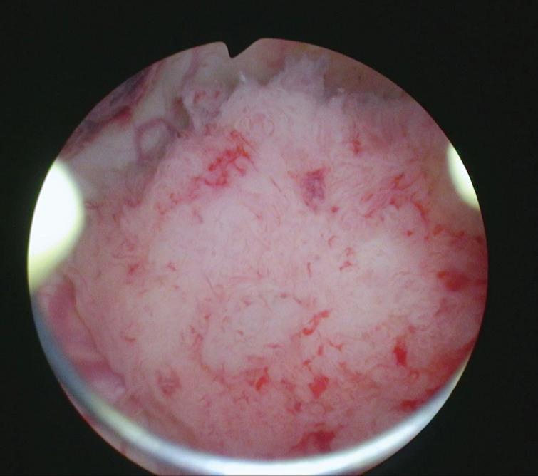 Papillary tumor left wall of the bladder.