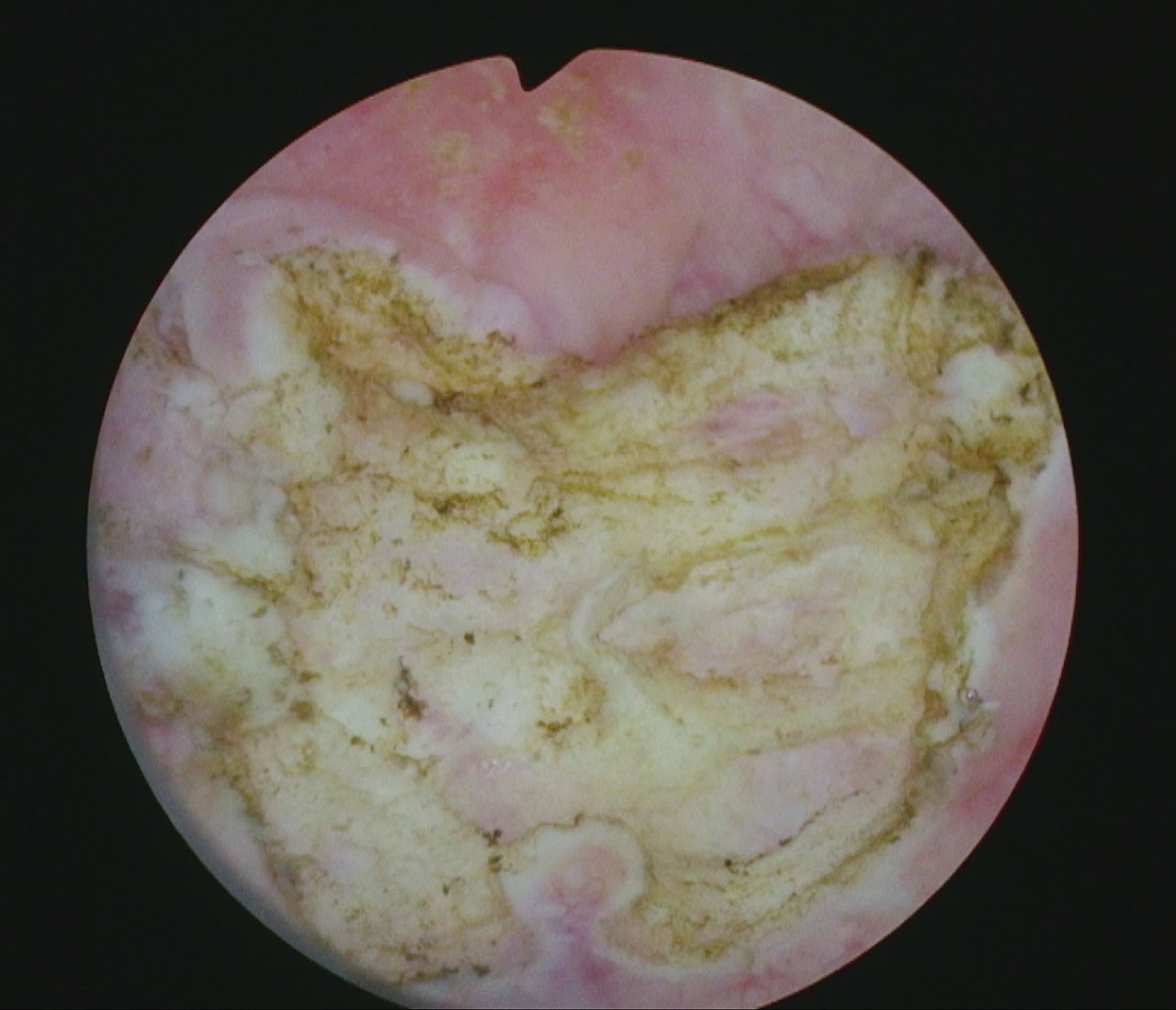 Appearance of the bladder after the resection.