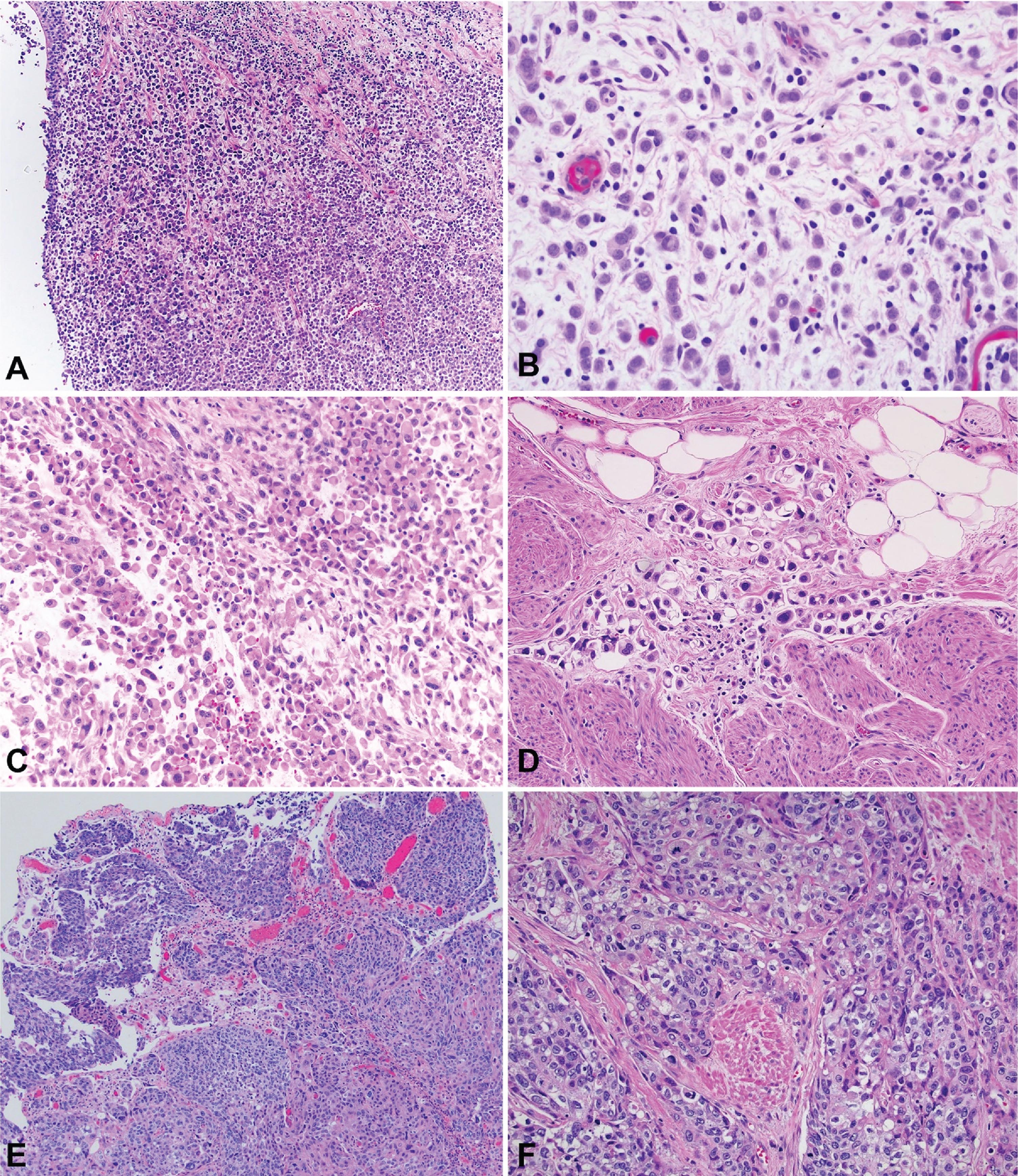 Photomicrography of bladder tumors. A – Plasmacytoid urothelial carcinoma (40x). B - Plasmacytoid urothelial carcinoma (200x). C – Plasmacytoid urothelial carcinoma with rhabdoid features (100x). D – Plasmacytoid urothelial carcinoma with signet ring features (200x). E – Conventional urothelial carcinoma (40x). F – Conventional urothelial carcinoma with muscle invasion (100x).