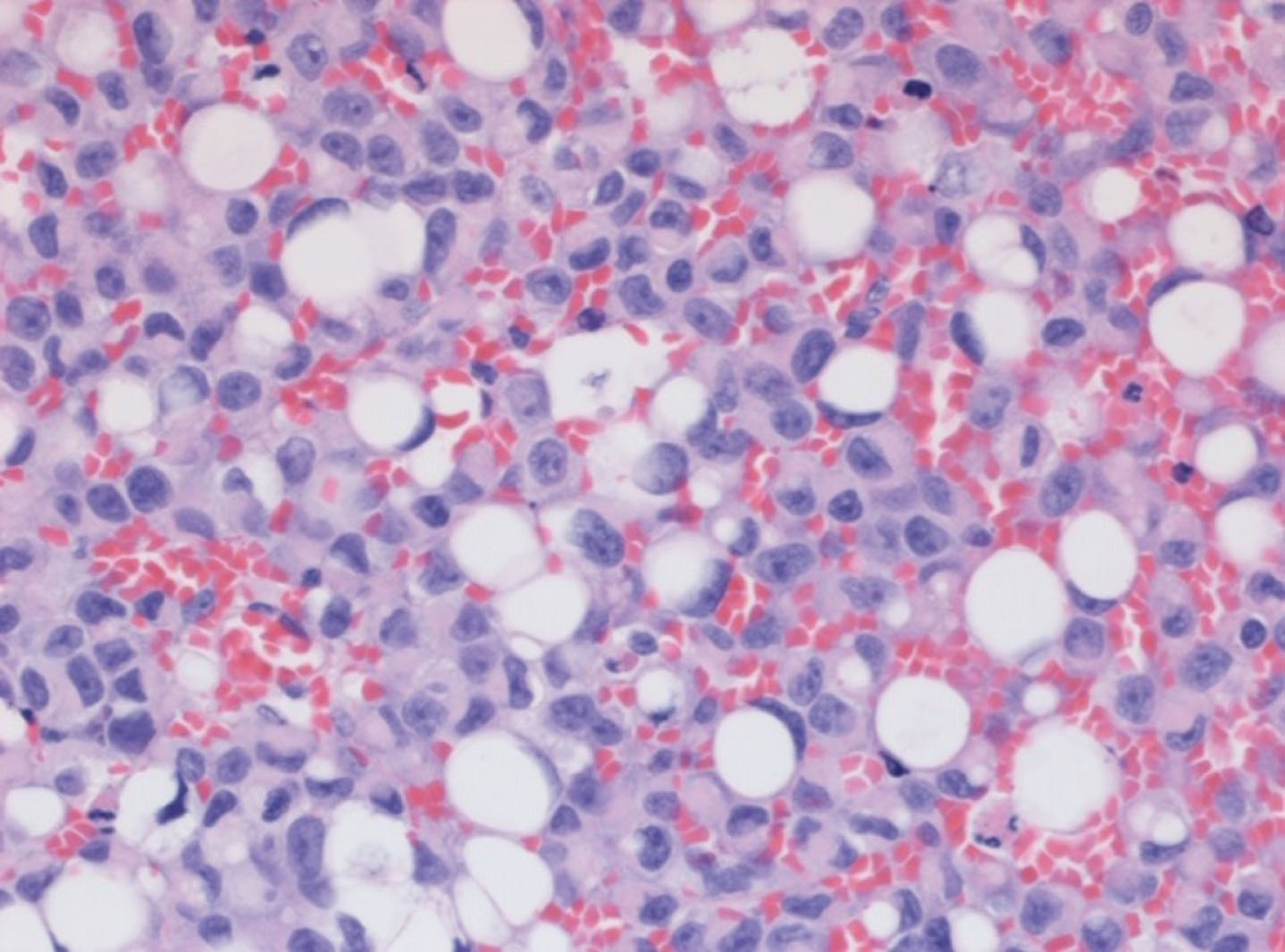 High grade Ta with plasmacytoid and signet cell features.