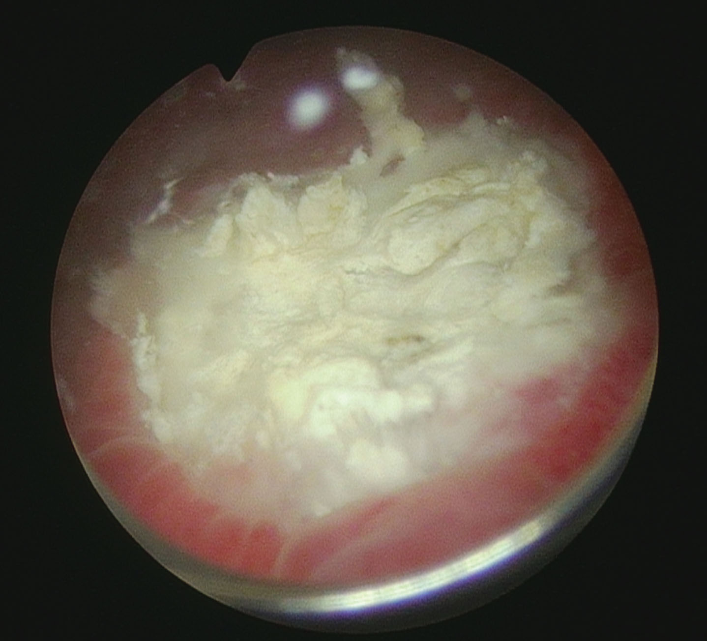 Appearance of bladder before third TUR of the bladder. Necrotic surface.
