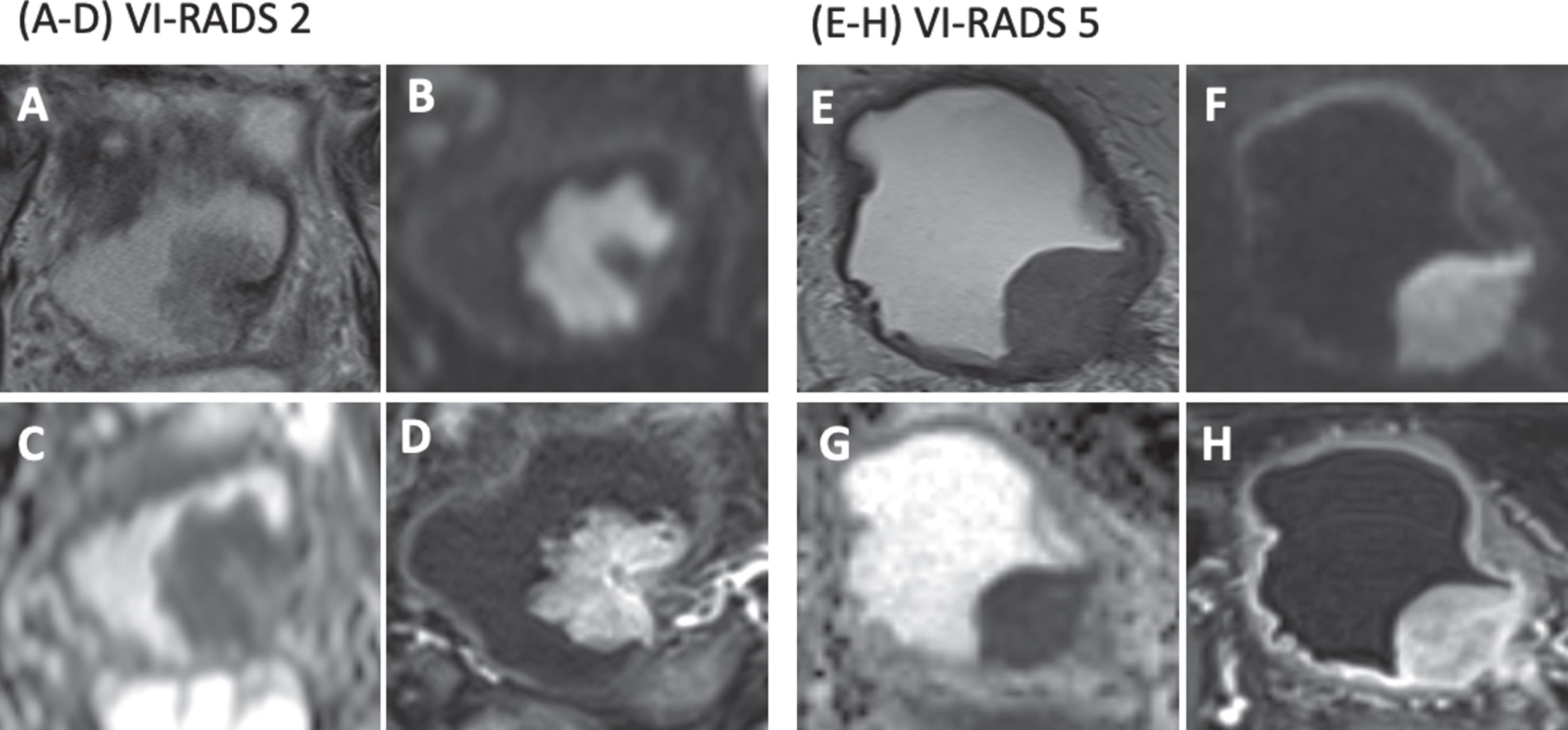 Representative MR images of bladder cancer with VI-RADS 2 and 5. A-D, MRI pictures in an 84-year-old man with pT1, G2 urothelial carcinoma. The VI-RADS score is 2. (A) An axial T2-weighted image shows a mass near the left ureteral orifice. (B) An axial b1000 DWI shows a hyper-intense mass with a hypo-intense central stalk, resembling an inchworm. (C) An ADC map. The mean absolute tumor ADC and sT-ADC were 1.25×10-3 mm2/s and 0.96, respectively. (D) A DCE-MRI shows early enhancement of the tumor but not the muscular layer. E-H, MRI pictures in a 79-year-old man with≥pT2, G3 urothelial carcinoma. The VI-RADS score is 5. (E) An axial T2-weighted image shows a mass arising from the left ureteral orifice. (F) An axial b1000 DWI shows a hyper-intense mass involving the muscular layer. (G) An ADC map. The mean absolute tumor ADC and sT-ADC were 0.84×10-3 mm2/s and 0.54, respectively. (H) A DCE MRI shows early enhancement of a tumor involving the muscular layer.