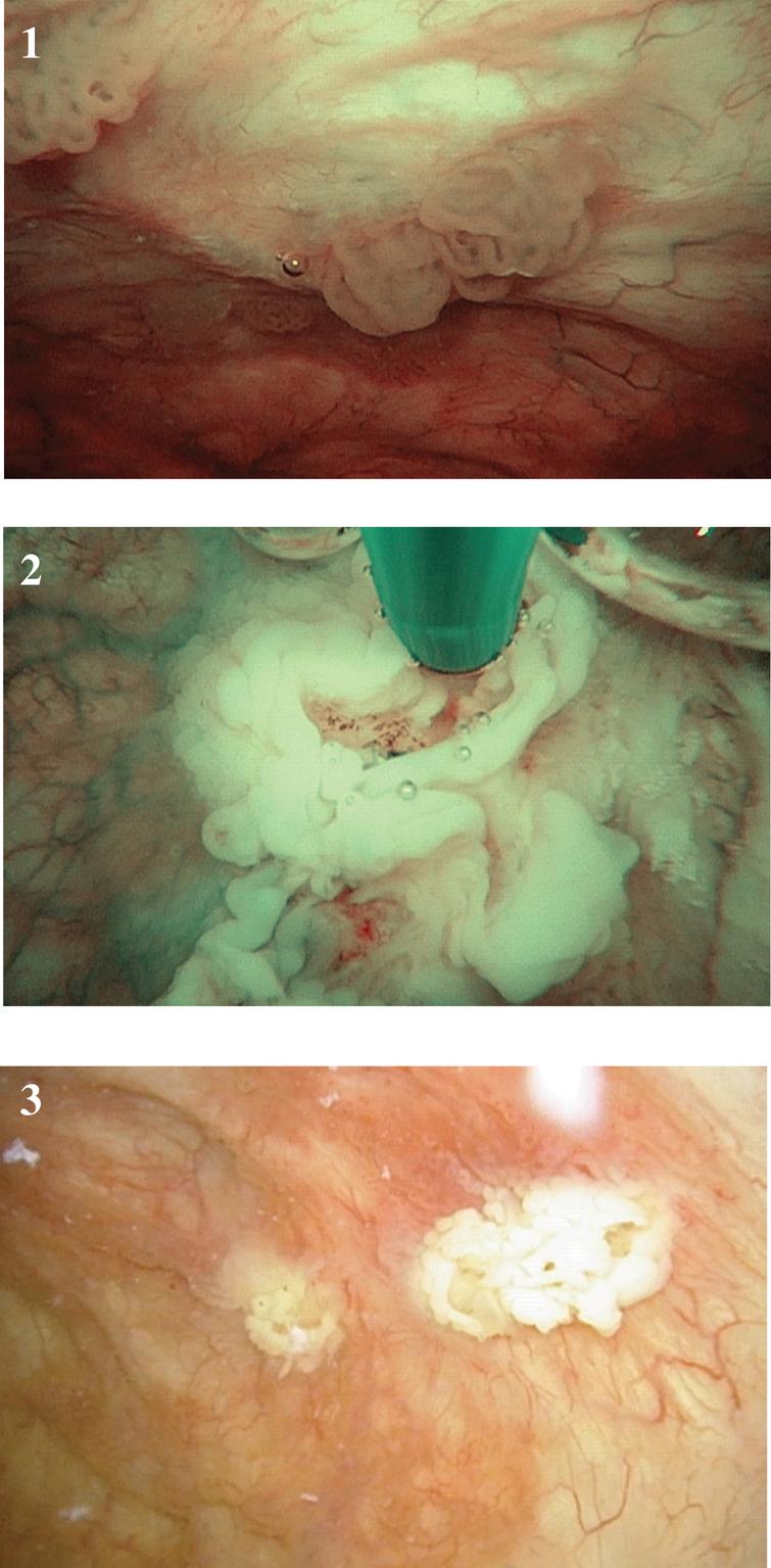 Small papillary low grade Ta appearing bladder tumors cauterized in the office setting using topical anesthesia.