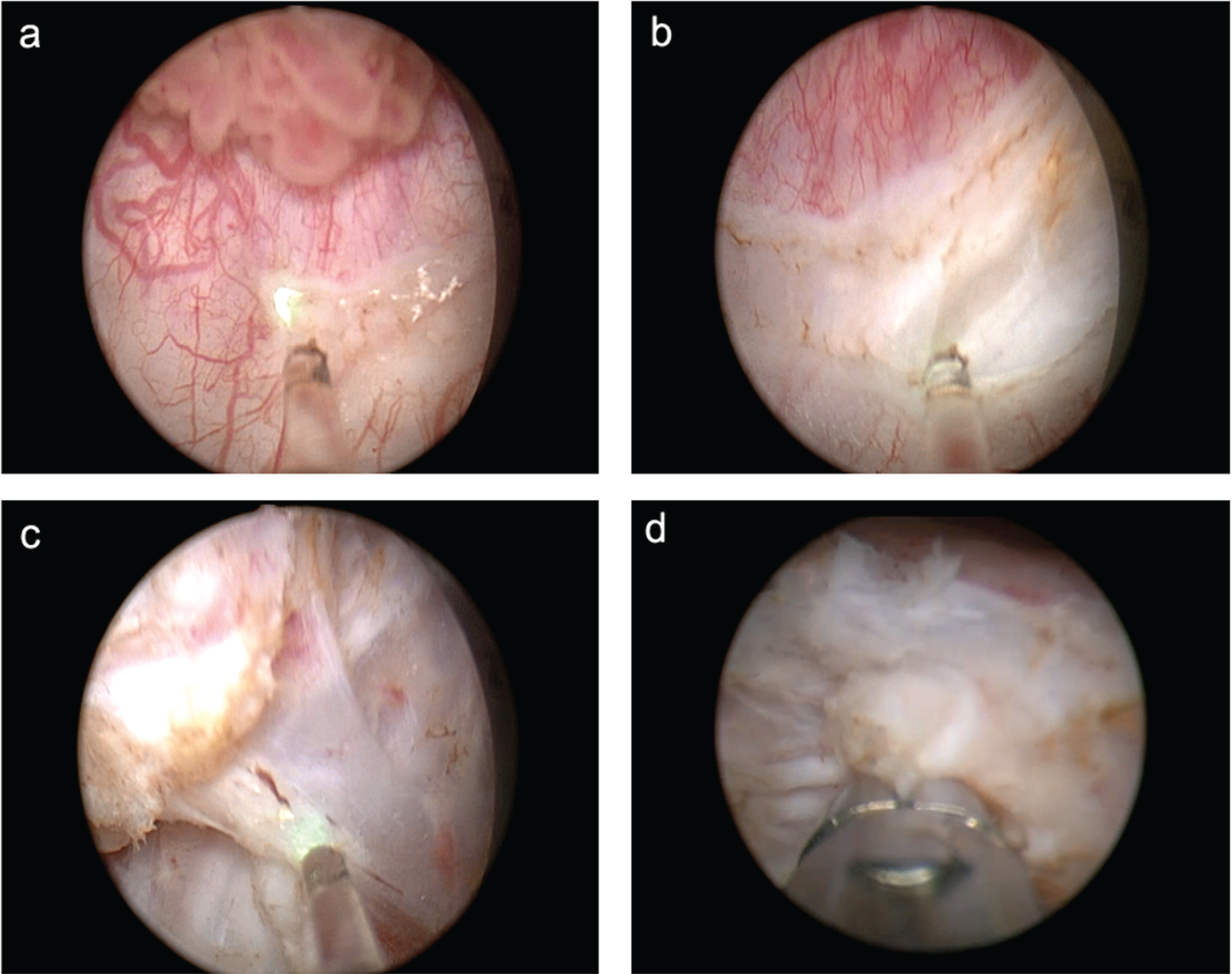 Stages of en bloc resection: incision in the mucosa (a), incision in the muscular layer (b), resection of the tumor base from the surgical site (c), random biopsy from the surgical site (d).