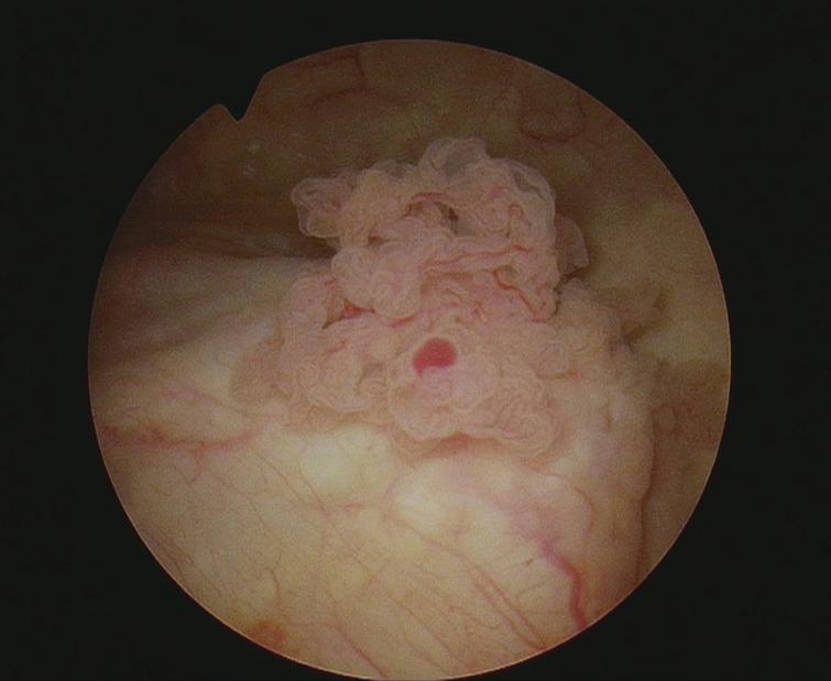 Papillary tumor just superior to the left ureteral orifice.