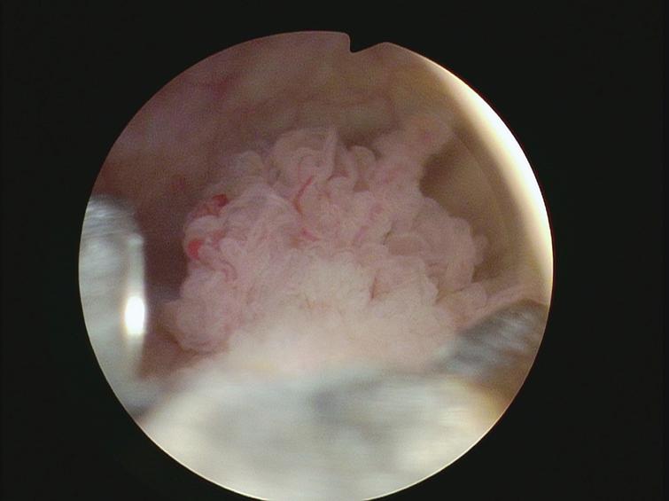 Cold cup removing larger tumor.