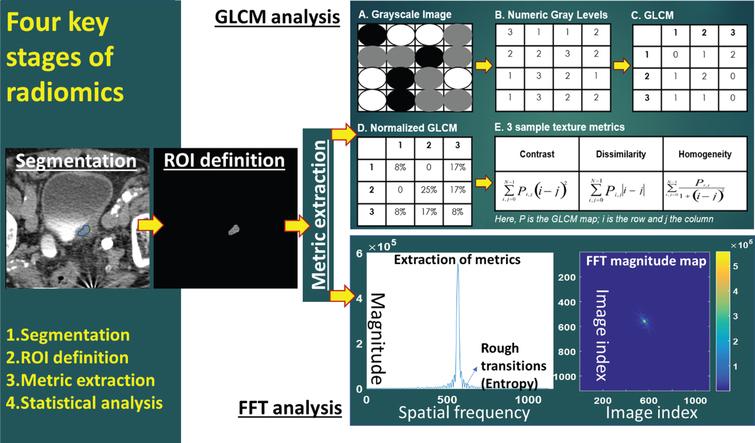 Workflow of radiomics (ROI = region of interest; GLCM = gray level co-occurrence matrix; FFT = fast Fourier transform).