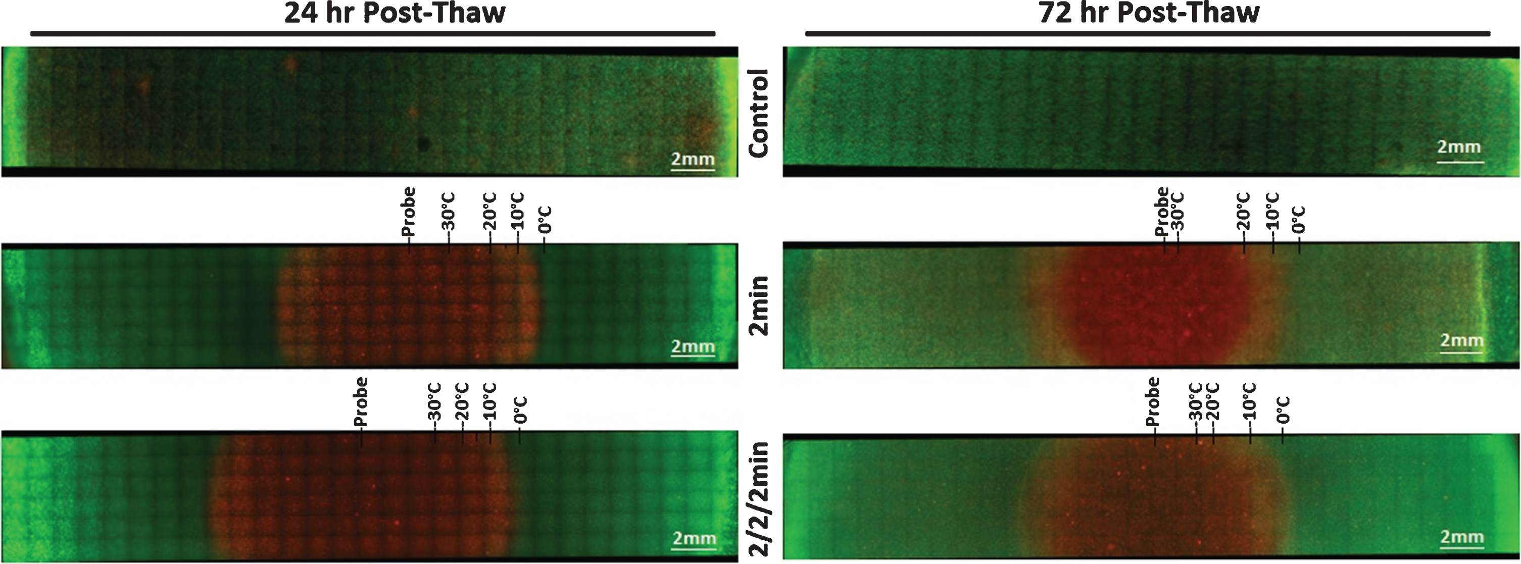 Fluorescent Micrographs of the SCaBER-TEMs Following Single and Double 2 min Freezes. At 24 hr (A) and 72 hr (B) post-thaw, unfrozen controls, single freeze, and double freeze TEMs were probed with Calcein-AM (green, live) and Propidium Iodide (red, dead) and visualized using fluorescent microscopy to determine the extent of cell death. Images were stitched together from a 6×30 set of overlapping images using a 10X objective. Measurements were made using the Zeiss ZEN software and temperatures from the corresponding IR images were mapped to the micrographs.