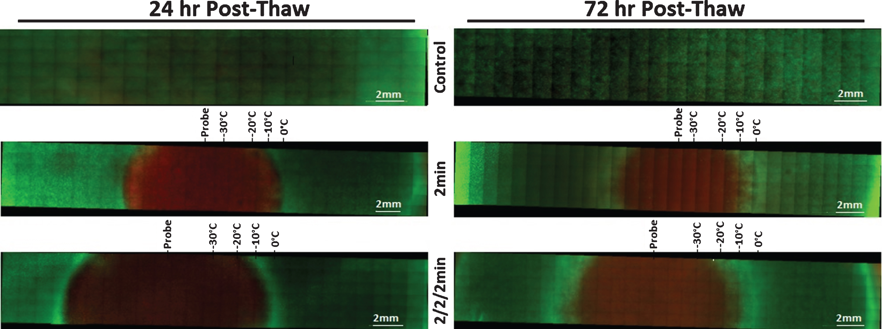 Fluorescent Micrographs of the UMUC3-TEMs Following Single and Double 2 min Freezes. At 24 hr (A) and 72 hr (B) post-thaw unfrozen controls, single freeze, and double freeze TEMs were probed with Calcein-AM (green, live) and Propidium Iodide (red, dead) and visualized using fluorescent microscopy to determine the extent of cell death. Images were stitched together from a 6×30 set of overlapping images using a 10X objective. Measurements were made using the Zeiss ZEN software and temperatures from the corresponding IR images were mapped to the micrographs.