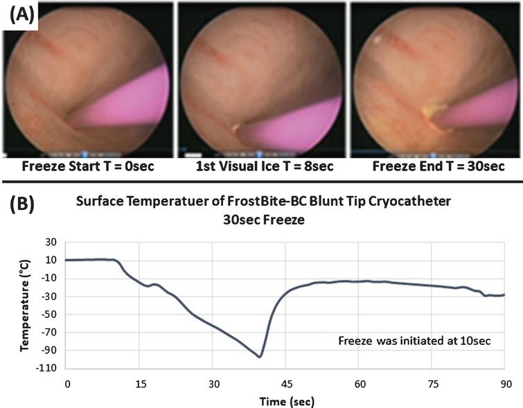 Time Lapse Cystoscopic Images and Thermal Profile of an In Vivo Porcine Freeze Procedure. Images (A) illustrate the application of a 30 sec freeze in the bladder performed via transurethral introduction with cystoscopy guidance. Images depict probe positioning (T = 0 sec), initial visual ice (T = 8 sec), and the final frozen tissue mass (T = 30 sec). Temperature monitoring of the probe tip surface (B) revealed a nadir temperature of – 96.4°C and the resulting lesion created an ablated area of bladder wall tissue ∼12 mm in diameter.