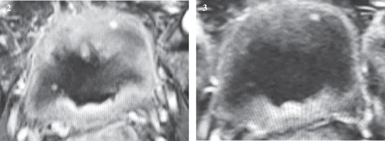 Images of the bladder with space occupying masses.