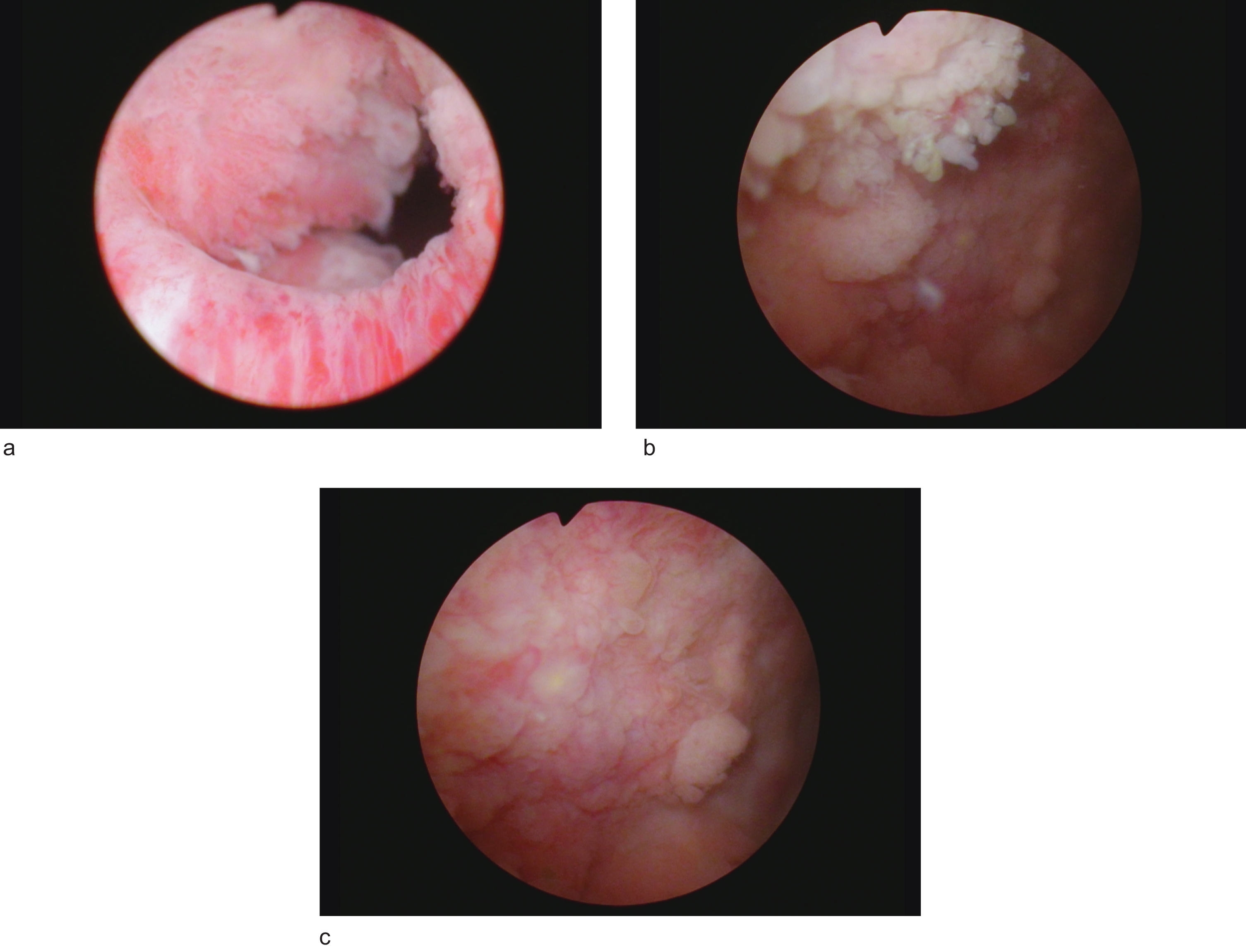 a. Papillary tumor right bladder neck. b,c. Multifocal papillary bladder tumors right lateral and posterior wall.
