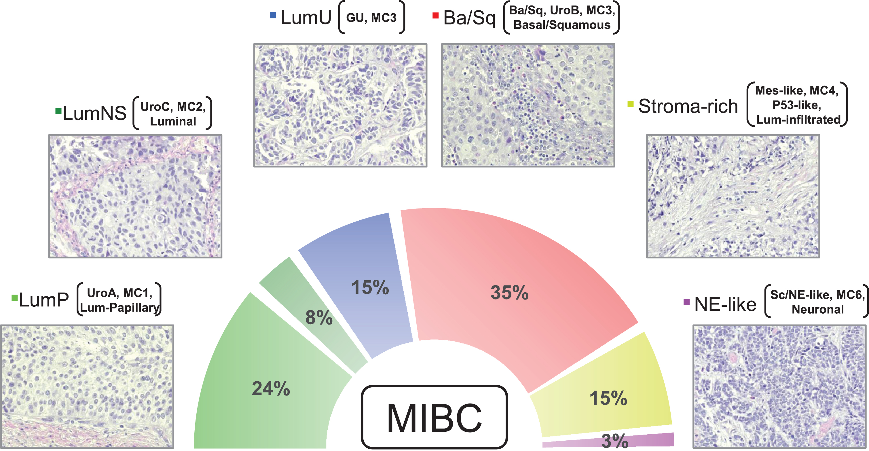 Micrographs of one representative hematoxylin & eosin stained tumor for each consensus subtype is shown (200×). The figure exemplifies the typical histomorphological patterns for each consensus subtype: Luminal-papillary, relatively organized urothelial histology; LumNS, less organized urothelial histology; LumU, severely disorganized urothelial histology; Ba/Sq, squamous differentiation; Stroma rich, Infiltrative growth pattern with stromal reaction; NE-like, Neuroendocrine differentiation. While the neuroendocrine tumors have neuroendocrine molecular features, they may not have neuroendocrine histology. Percentages show the proportion of MIBC tumors belonging to each subtype based on data in Kamoun et al. (2019). In addition to the consensus subtype nomenclature, subtypes from other classification systems (Lund, CIT-Curie, MDA, and TCGA) enriched in each of the consensus subtypes are shown in brackets.