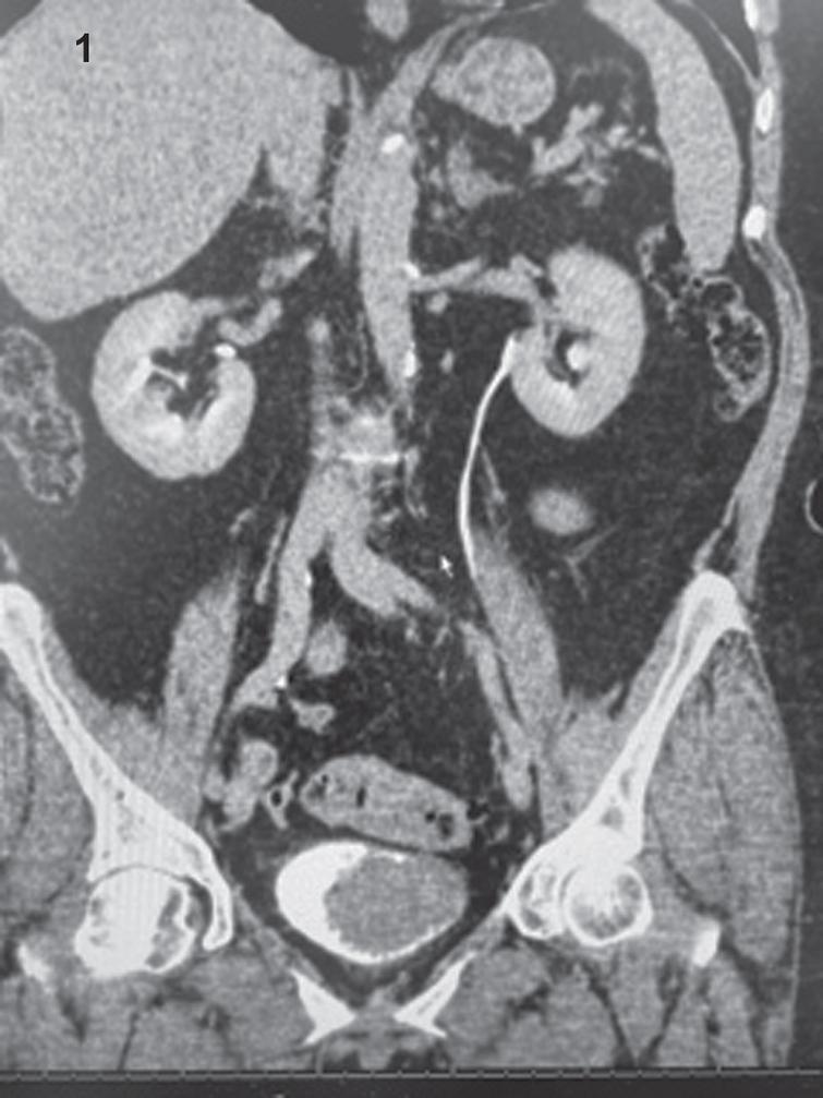 CT images demonstrating large filling defect in the bladder.