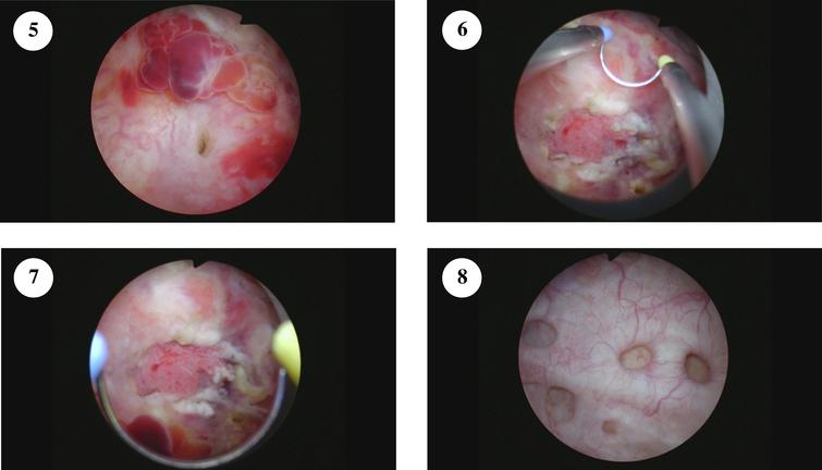 The right ureteral orifice is identified in figure 5. The tumor is seen in figures 6–7.
