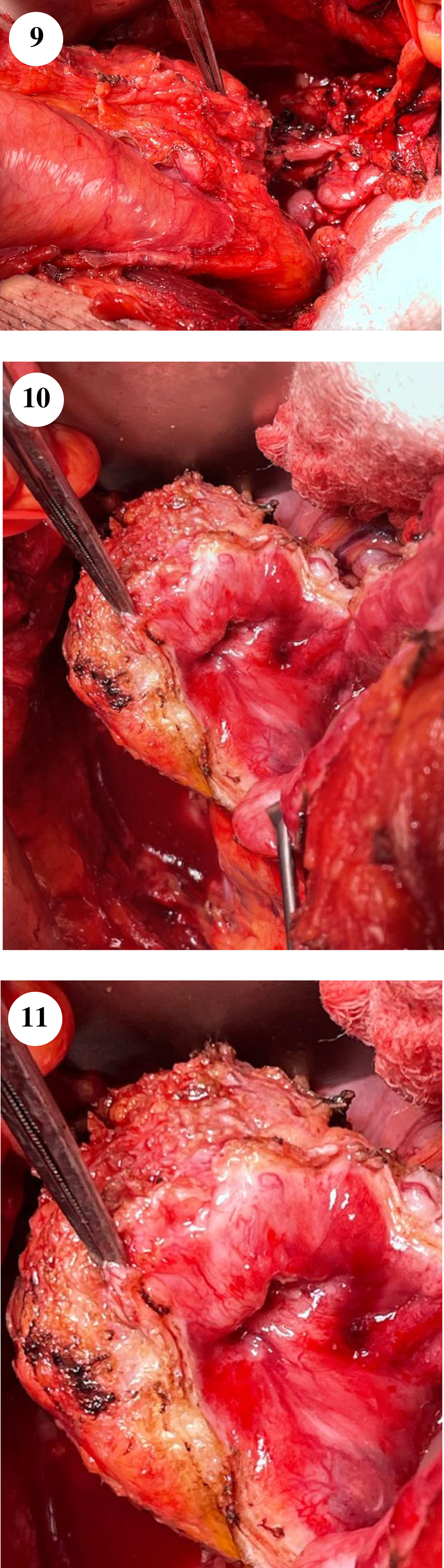 The firm mass is seen in figure 9 with the instrument pointing to it. The mobilized right distal ureter is seen proximal to the bladder. Figures 10–11 show the tumor containing bladder diverticulum.