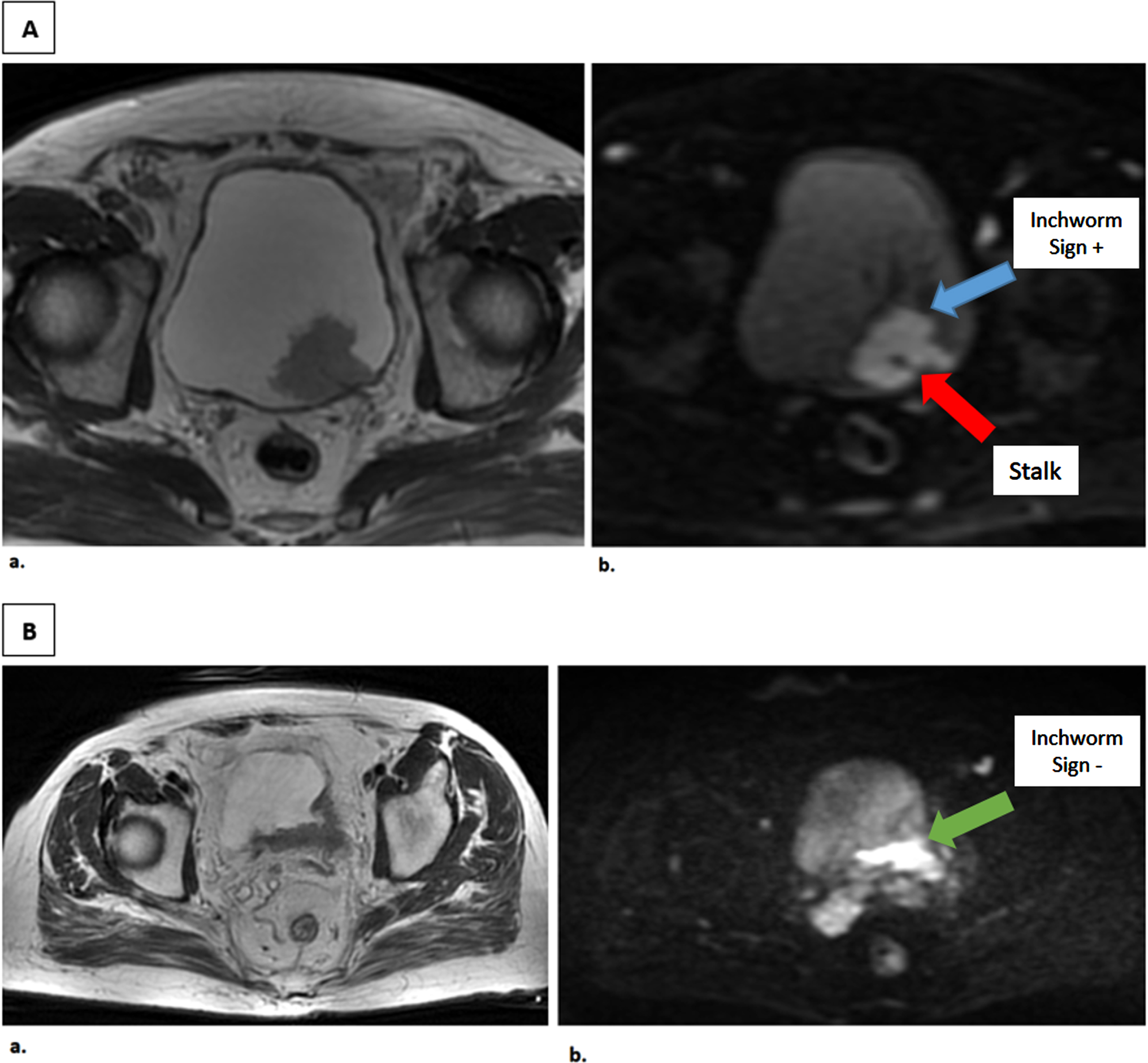 T2-weighted and Diffusion-weighted Images of patients with and without Inchworm sign. A. Axial MR images of a male patient with a 3 cm tumor on the posterior bladder wall. a. T2-weighted image b. Diffusion-weighted image tumor with high SI area with a low SI stalk, as an inchworm sign. TUR-BT revealed pT1 high grade papillary urothelial carcinoma without muscle invasion. B. Axial MR images of a male patient with 4.1 cm tumor on the posterior bladder wall. a. T2- weighted image b. Diffusion-weighted image tumor without inchworm sign. TUR-BT revealed T2 high grade papillary urothelial carcinoma and Radical cystectomy was performed, pathology resulted as pT3 high grade.