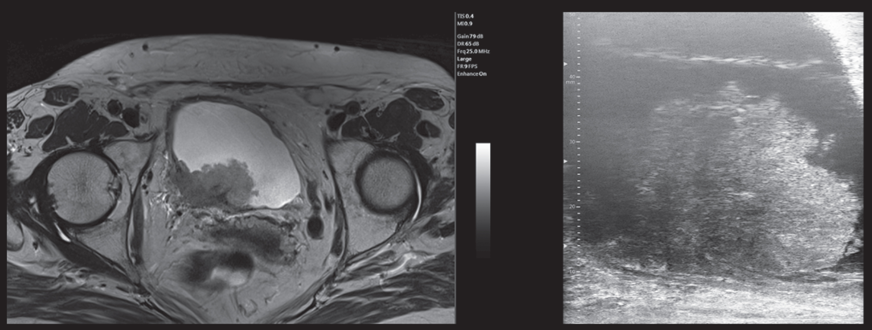 mUS and MRI imaging comparison, patient 1. In the mUS the tumor disrupts the three layer structure showing a mixed hypo and hyperechoic pattern and at MRI the tumor extends beyond the bladder wall. In both techniques a single large stalk can be detected. (abbreviations: mUS: microultrasound; MRI: magnetic resonance imaging).
