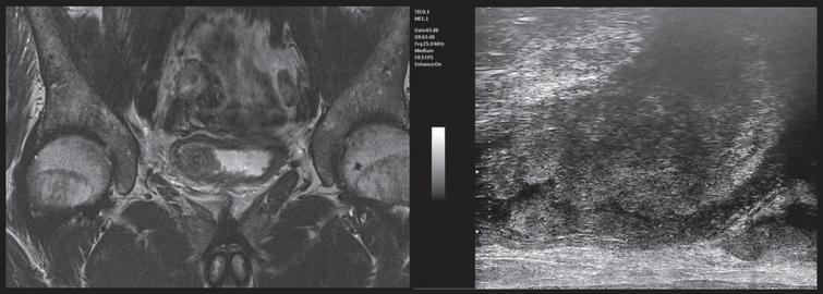 mUS and MRI imaging comparison, patient 2. In both the mUS and mpMRI imaging the tumor is clearly extending into the muscular layer, showing a hyperechoic aspect at the base of the lesion associated with a ?starry sky? pattern and a clear extension beyond the bladder wall in MRI. (abbreviations: mUS: microultrasound; MRI: magnetic resonance imaging).
