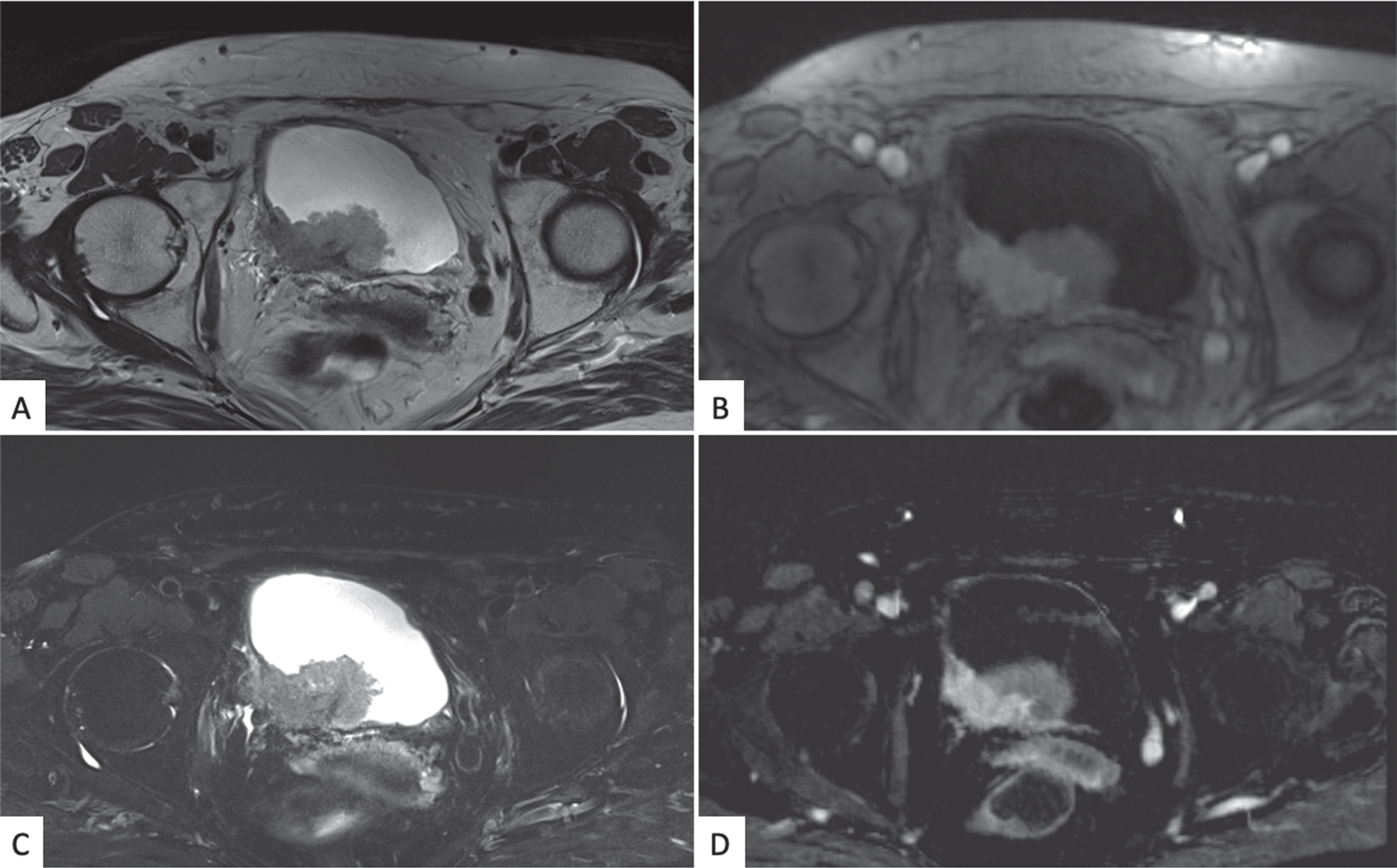 Bladder mpMRI: axial projection T2 weighted (A), DWI and ADC imaging (B and C), and dynamic imaging in arterial phase after paramagnetic contrast medium injection (D), The images show the presence of a large heteroplastic lesion of the poster bladder wall invading the fatty tissue around the bladder. (abbreviations: MRI: magnetic resonance imaging; DWI: diffused weighted imaging).