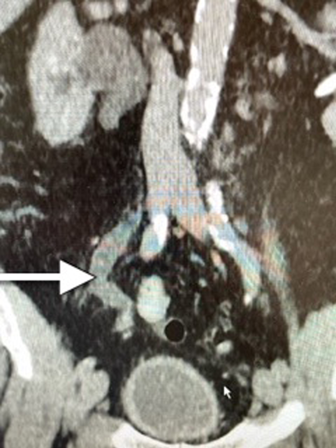 CT scan indicating dilated/obstructed right ureter identified by the arrow.