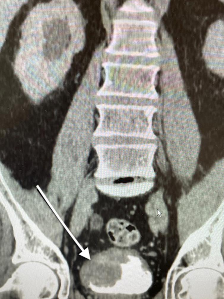 CT scan indicating the large tumor located at the trigone and obstructing the right ureter. The arrow points to the tumor.
