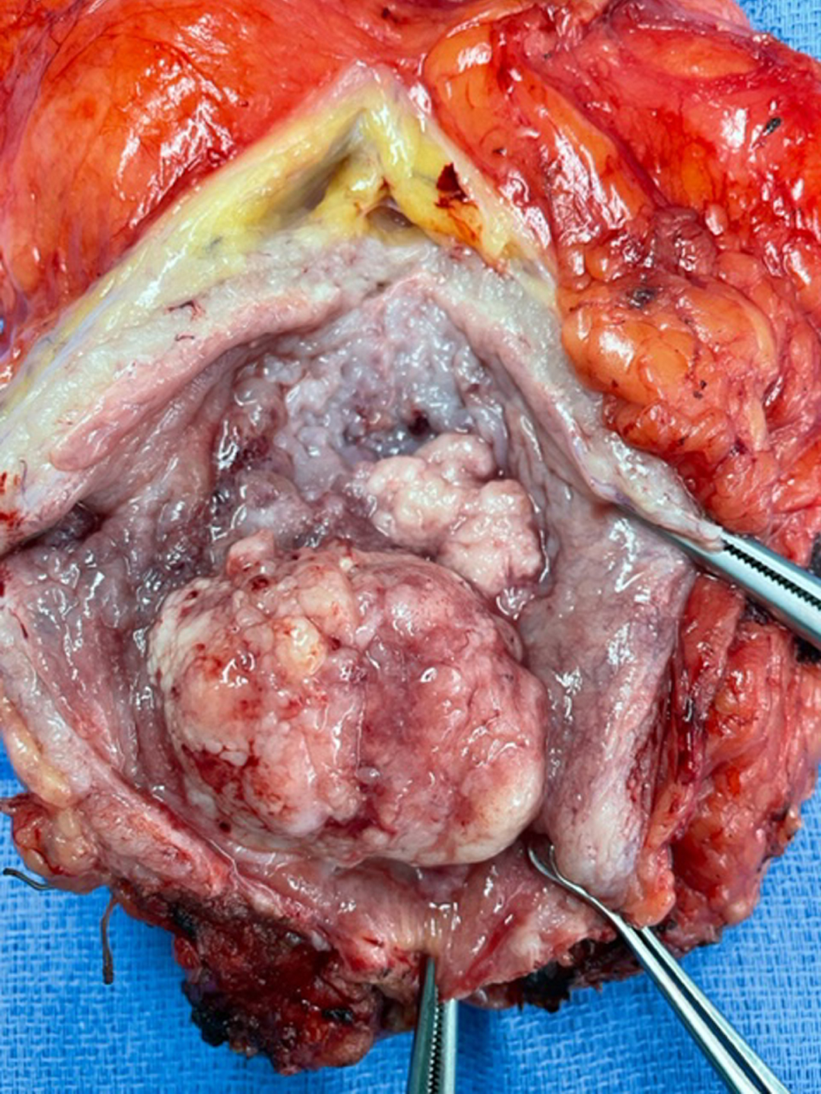 Photo of bladder opened anteriorly showing the large tumor and neighboring tumor.