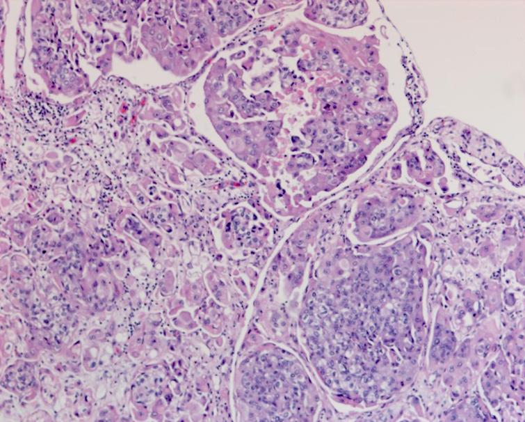 Pathology demonstrating the extensive carcinoma in situ as well as the high grade urothelial carcinoma with a prominent micropapillary pattern. The cancer invaded through the muscularis propria into the perivesical fat.