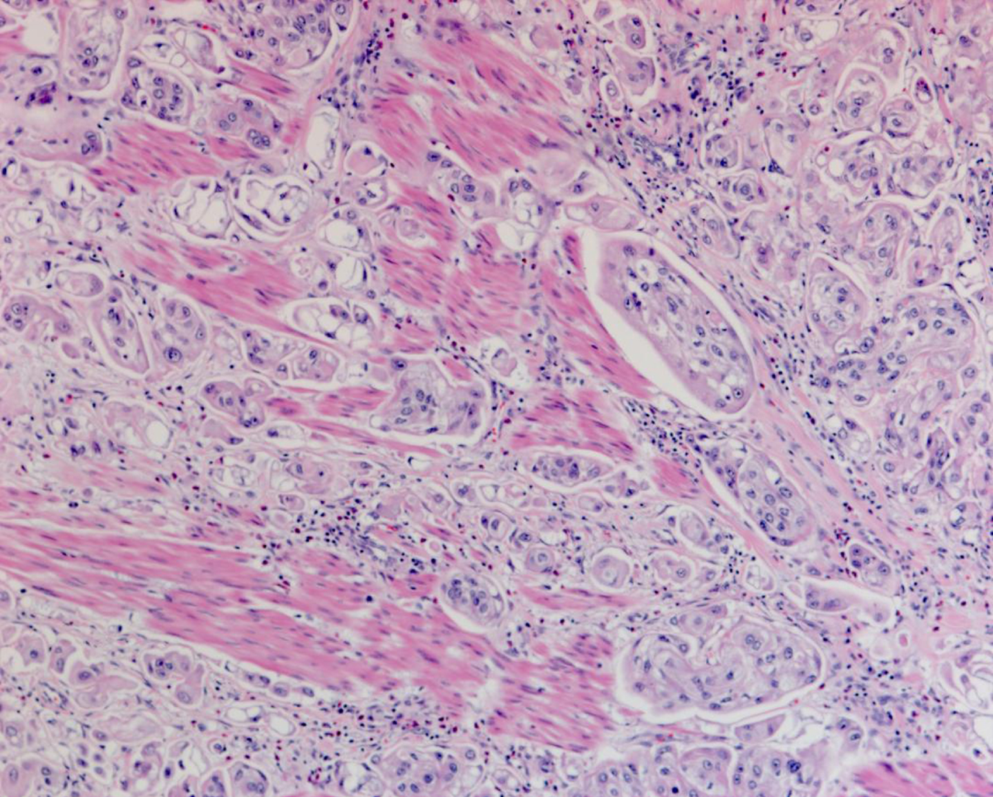 Pathology demonstrating the extensive carcinoma in situ as well as the high grade urothelial carcinoma with a prominent micropapillary pattern. The cancer invaded through the muscularis propria into the perivesical fat.