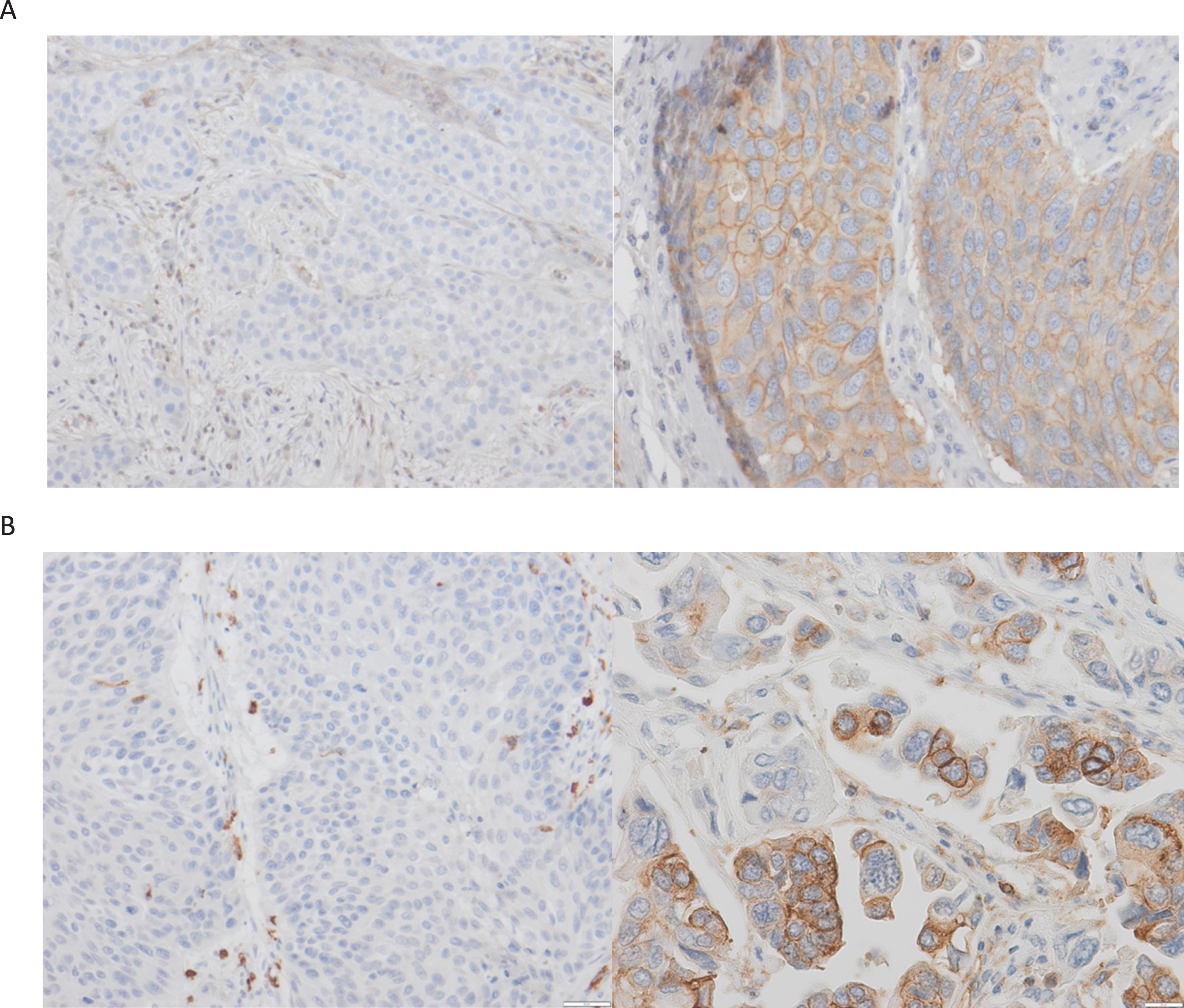 MHC immunohistochemistry.Image A: A case with complete lack of MHC I expression (left) and a case with >50% of MHC I-positive tumor cells (right). Image B: Same for MHC-II expression (400x magnification in positive cases to show membranous expression.