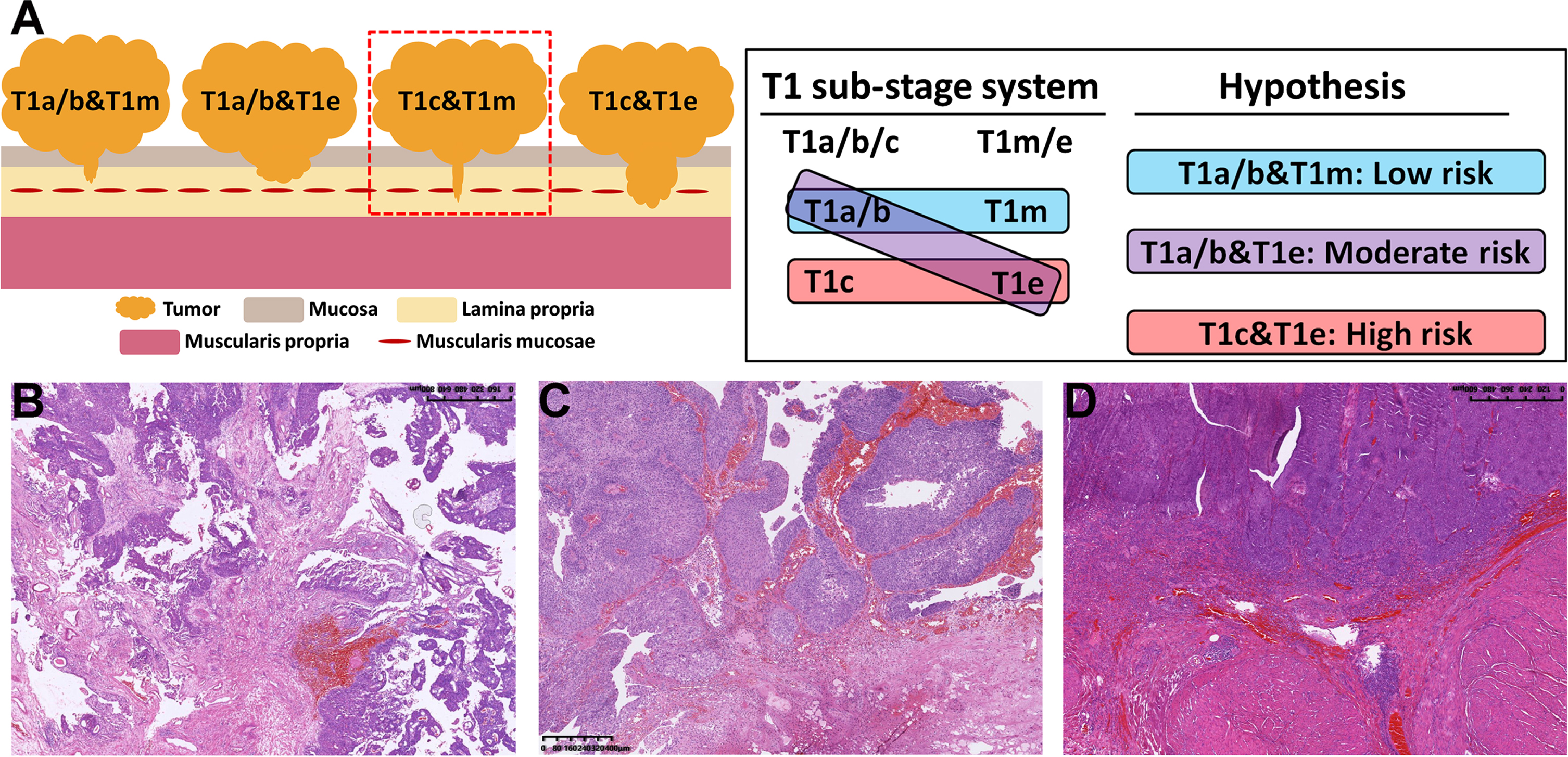 Schematic diagram (A) and the hematoxylin-eosin (HE) staining images (B D) of the combination of the T1a/b/c and T1m/e substaging systems. In our cohort, no tumor was both T1c and narrow T1m, so there were only three types of combinations, namely, T1a/b&T1m (B), T1a/b&T1e (C) and T1c&T1e (D), and we assumed that T1a/b&T1m had the best prognosis and T1c&T1e had the poorest prognosis.