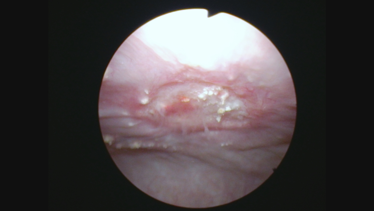 Endoscopic appearance of the abnormal urothelium in the location of the prior cancer location.
