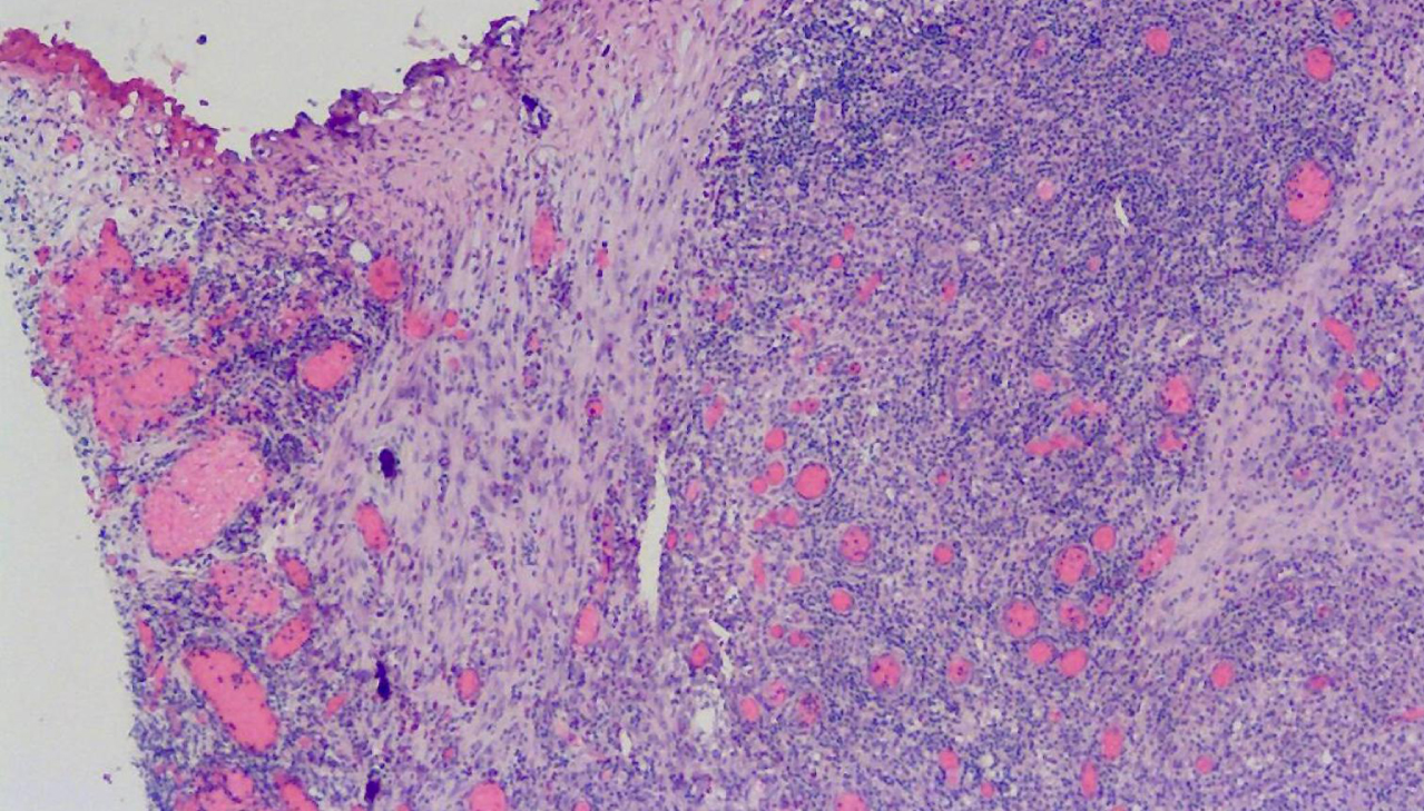 Pathology of the repeat resection showing no cancer; chronic inflammation only.