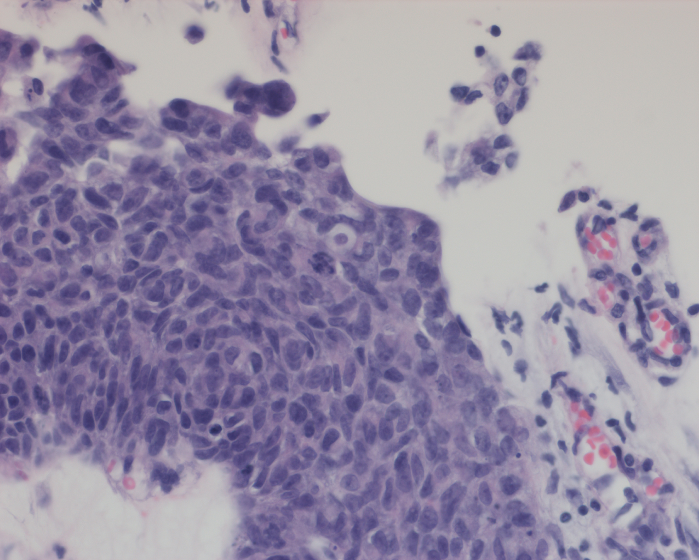 Papillary high grade urothelial carcinoma.