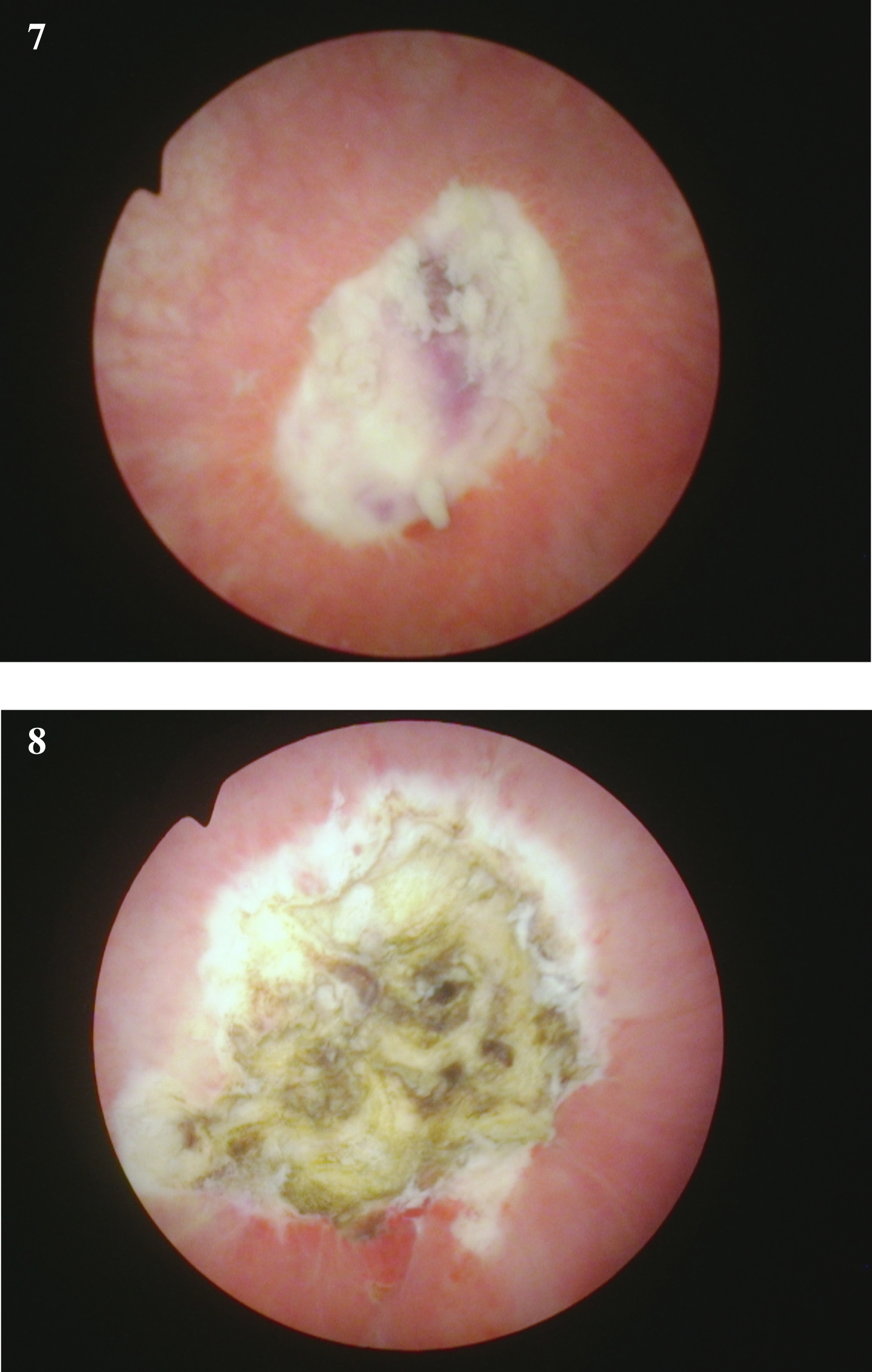 Endoscopic view at the time of the repeat TUR BT following the initial diagnosis of a of the high grade T1 urothelial cancer. The rest of the bladder was normal.