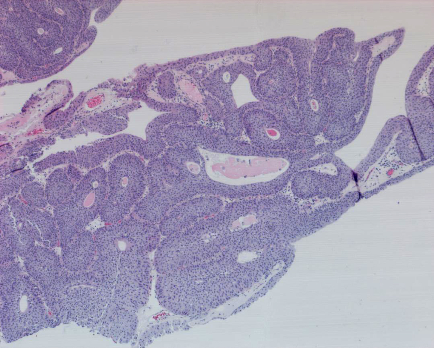 Fibroepithelial polyp with inverted papilloma features. It is benign.