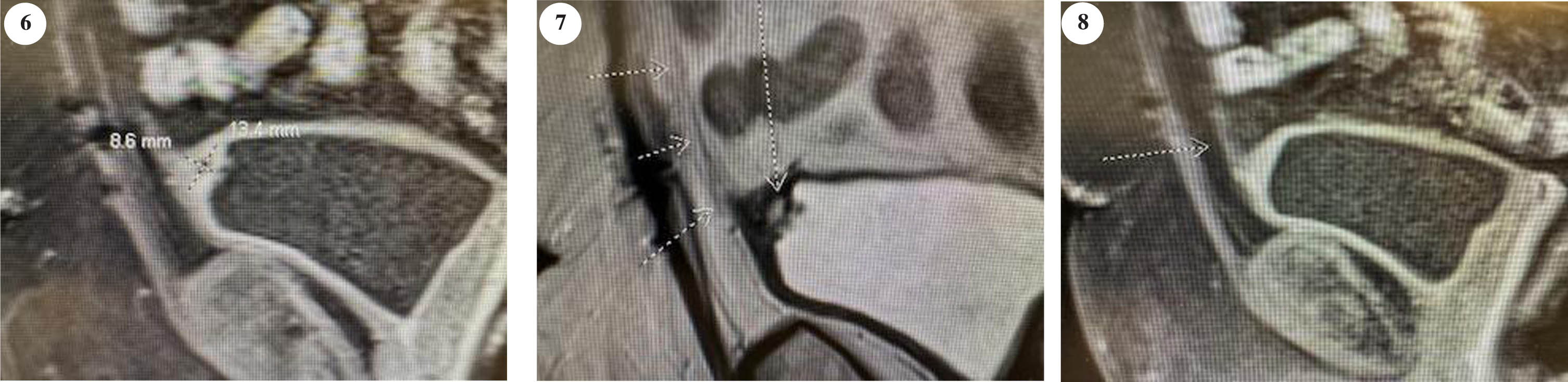 Post initial TUR BT imaging indicating mass involving the urachus.