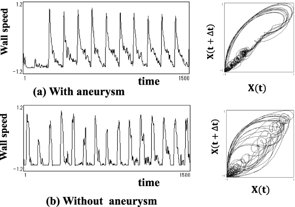 Original wave form and its trajectory by attracter analysis (A clinical example of not being feasible to judge the existence of aneurysm by its attracter analysis of the trajectory alone.)