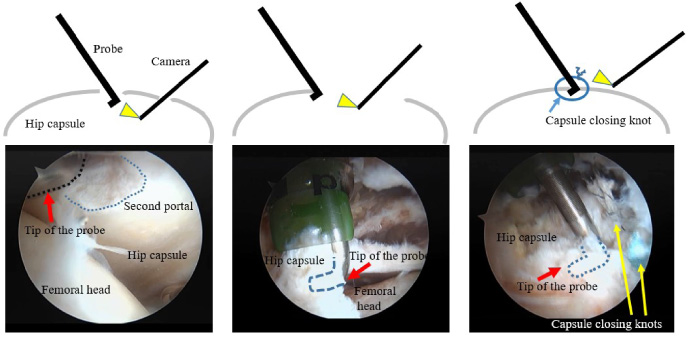Three measurement steps for investigation of capsule resistance while pulling with the probing device. The first step (closed capsule) is shown in the left figures (upper; a scheme, lower; an intracapsular view) and was done with the second portal open. Condition of the capsule is not open despite of the two open portals. The second step (open capsule) is shown in the middle figures (upper; a scheme, lower; an extracapsular view), and was performed while relocating of femoral head into the joint after labral procedures. The third step (closured capsule) is shown in the right figures (upper; a scheme, lower; an extracapsular view) after capsule closure with some capsular closing knots. The tip of the probing device was inserted into the capsule through a gap between the closing knots.