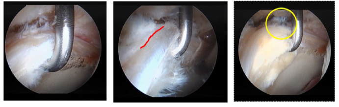 Three measurement steps for investigation of labrum resistance while pulling with the probing device. The step in the left figure is the intact phase. The step in the middle figure is after detaching the labrum (line indicates this). The step in the right figure is after labral repair (circle indicates knots for the repair).