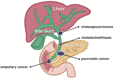 Diagram of the hepatobiliary system. Each disease causes the obstruction of the bile duct.