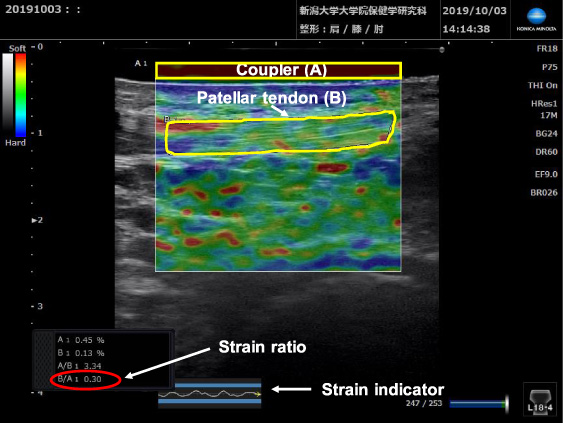 Strain and B-mode images of the middle portion of the patellar tendon. The strain indicator, the strains of the tendon (B) and, the coupler (A) are displayed. The ROI of the coupler is indicated as a yellow rectangle, the tendon portion measured is outlined in yellow and, the strain ratio of the tendon is indicated in red.