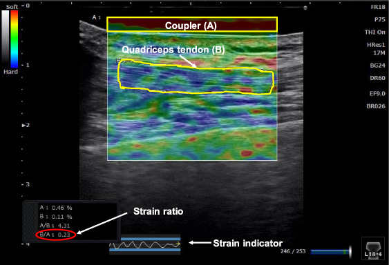 Strain and B-mode images of the middle portion of the quadriceps tendon. The strain indicator, the strains of the tendon (B) and the coupler (A) are displayed. The ROI of the coupler is indicated as a yellow rectangle, the tendon portion measured is outlined in yellow and the strain ratio of the tendon is indicated in red.